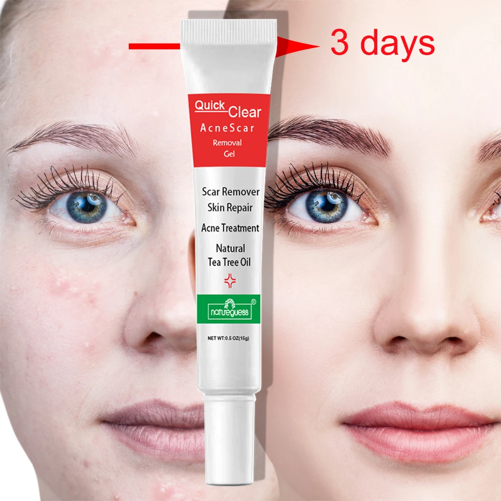 Эффективный крем для удаления акне лечение увлажнение отбеливание уход за кожей