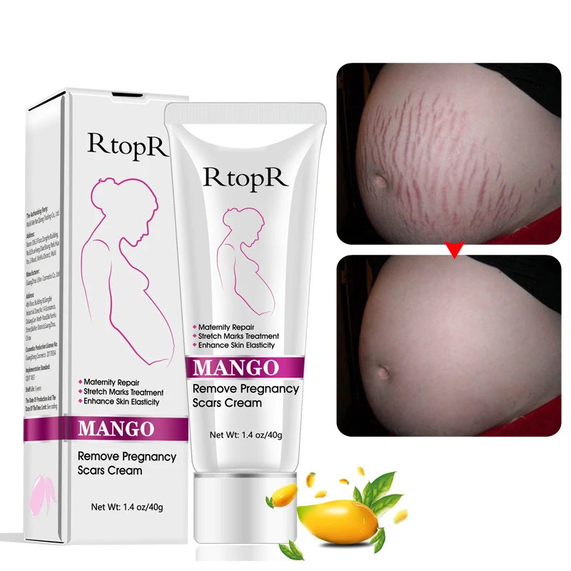 RtopR манго удаляет беременность крем от шрамов уход за кожей тела - Цена: 744,80 руб.