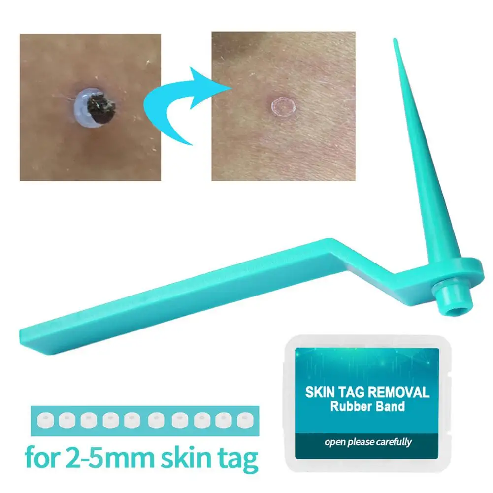 

Face Skin Care Mole Wart Tool For Small To Medium Blue Skin Tag Removal Kit With Cleansing Swabs Home Use Adult
