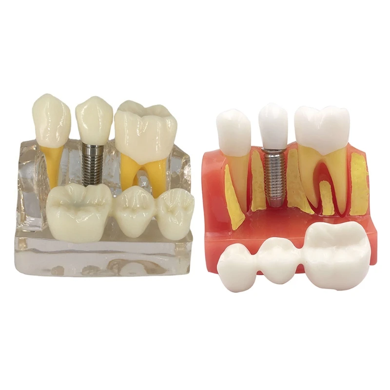 

Dental Dental Implant Model 4 Times Removable Crown Bridge Demonstration Class Education and Studying Teeth Model