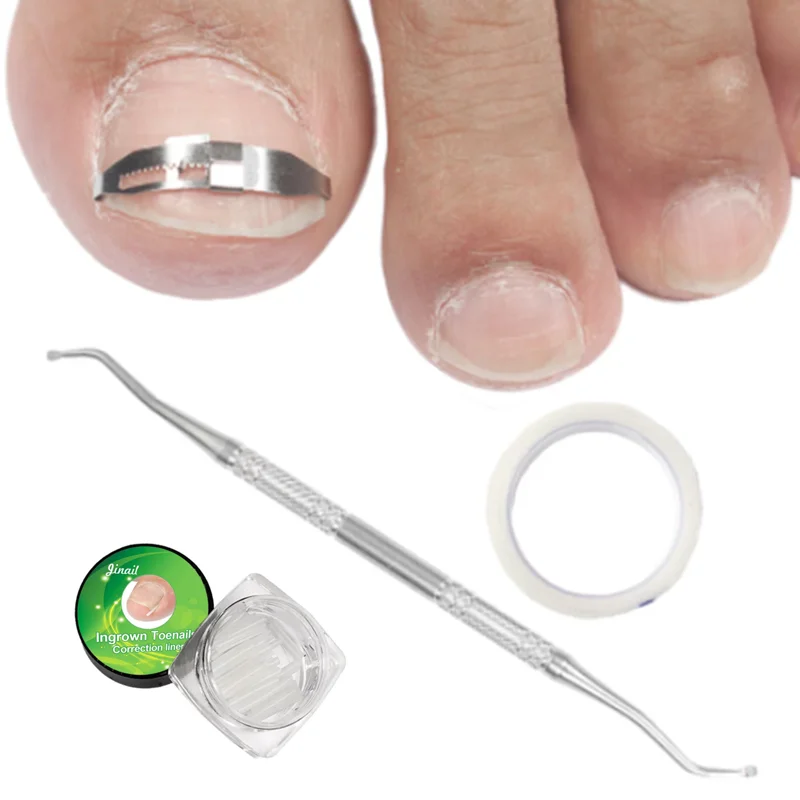 1 Набор инструмент для коррекции вросших ногтей лечения инкрустированная Пряжка