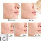 Увлажняющий крем для лица, устранение черных точек и сокращения пор