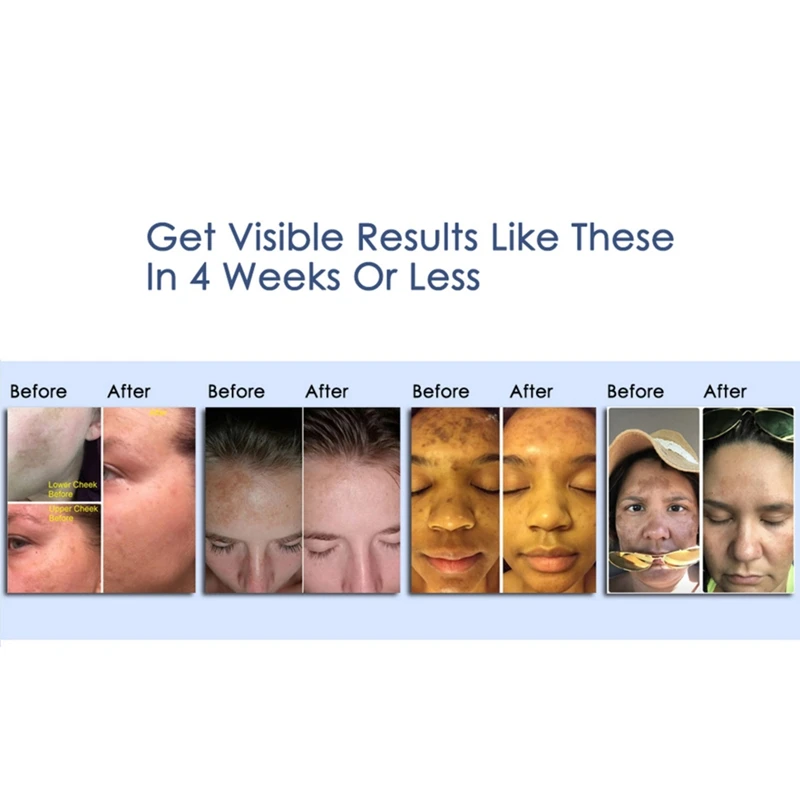 Отбеливающая Сыворотка для лица осветляет цвет кожи удаляет веснушки крем ухода