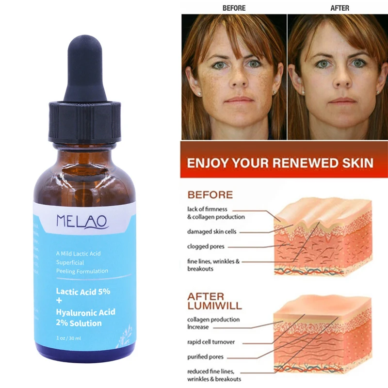 

Lactic Acid Skin Peel For Face Acne Wrinkles Melasma Age Spots Brightening Exfloliating Relieving Serum Skin Care