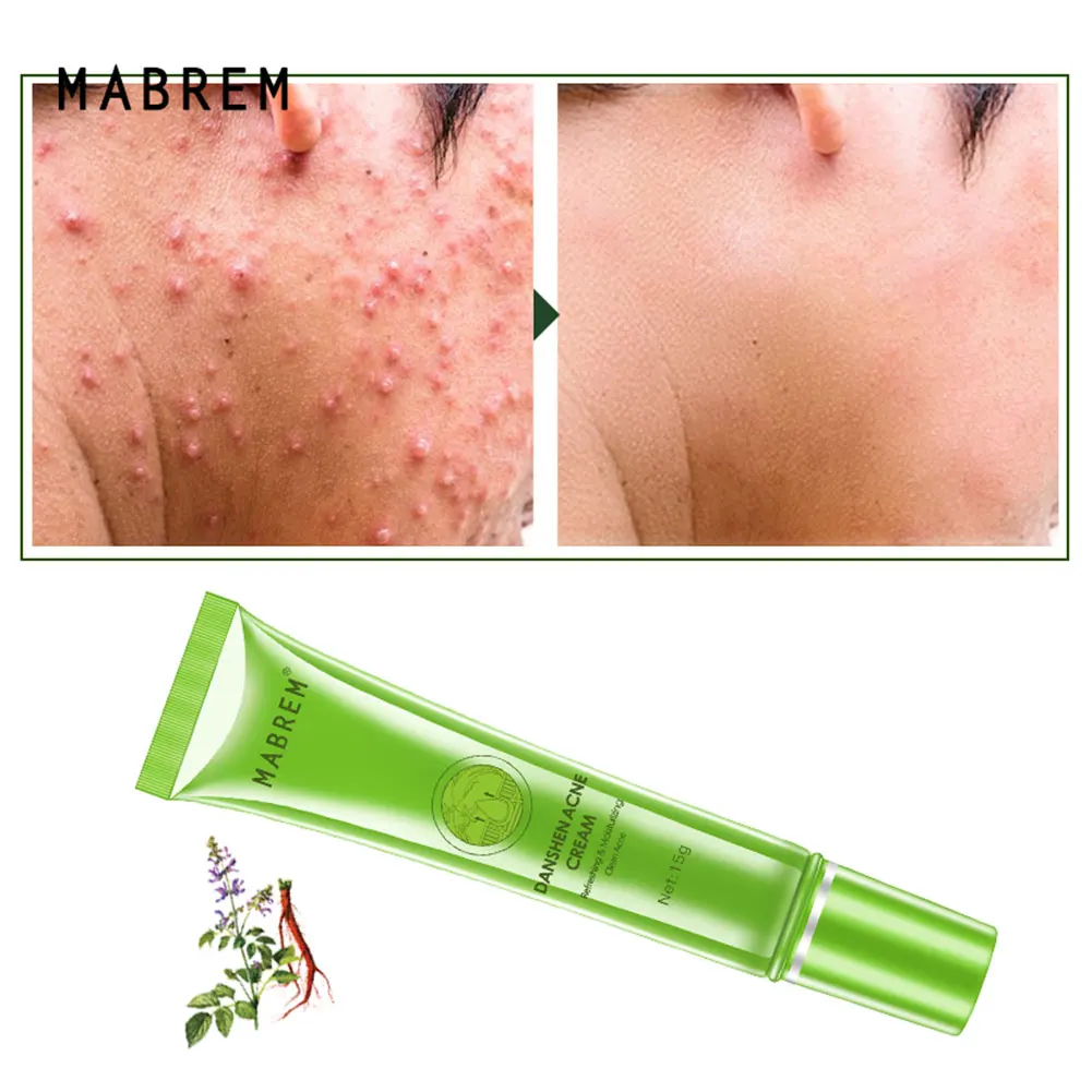 

15g Face Care Serum Acne Treatment Gel Cream Eliminate Acne Removal Cream Oil Control Brightening Moisturizer For Skin Care