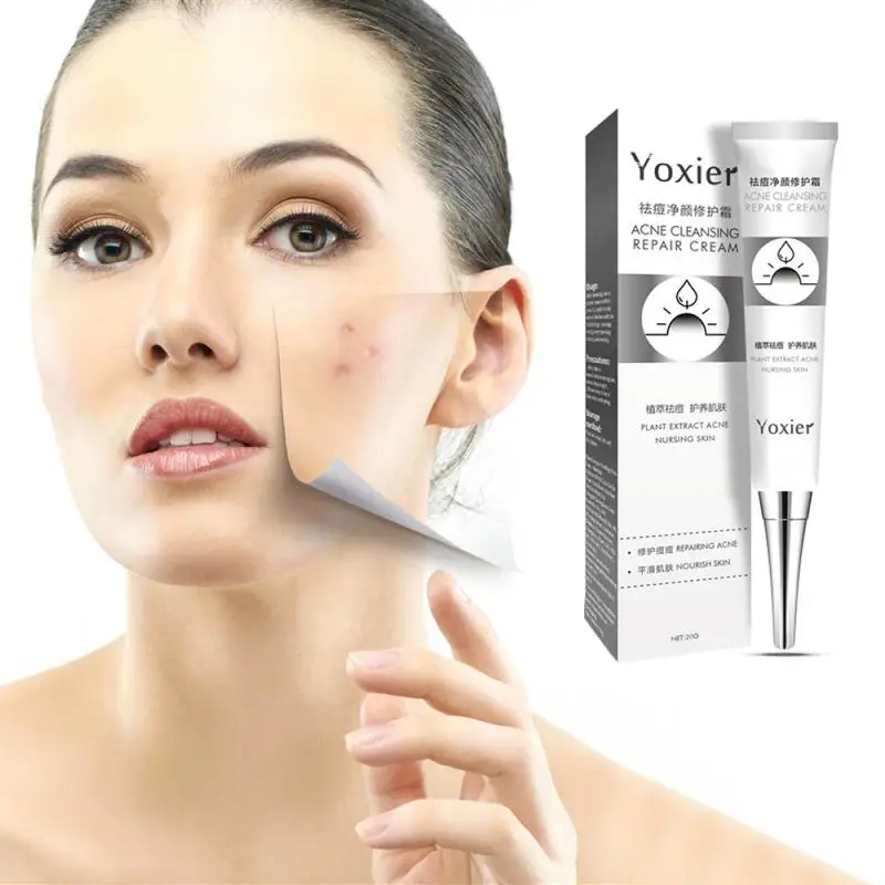 20 г крем для лечения акне удаления шрамов от угрей увлажняющий отбеливающий