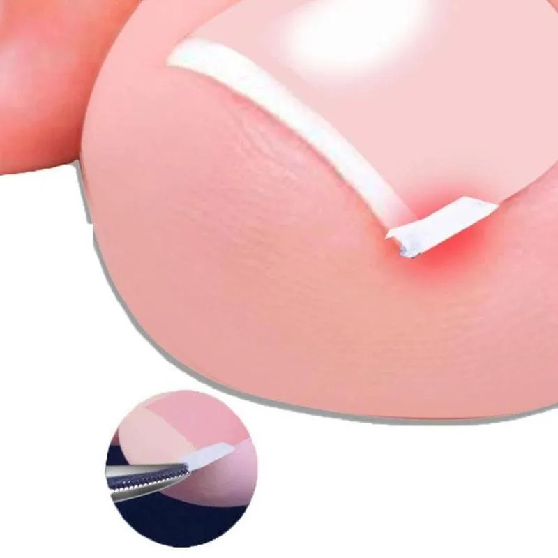 

10/12pcs Silicone Ingrown Nail Pad Foot Care Nail Groove Tool Nail Paronychia Ingrown Pad Corrector Pain Correction Relief L0E7