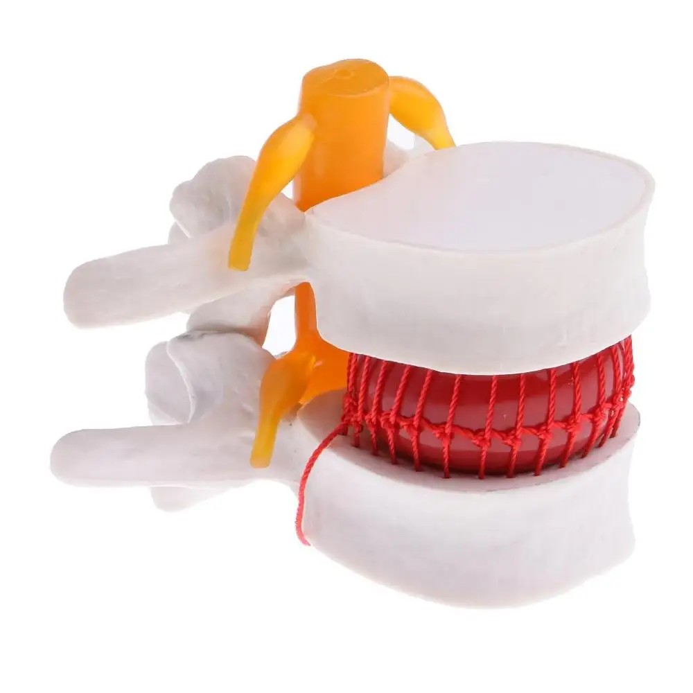 Человеческая медицинская анатомическая спина поясница дисковая грыжа