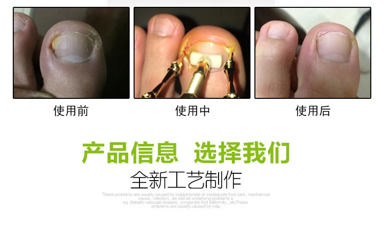 Ingrown корректор для ног из нержавеющей стали Уход за ногтями на ногах педикюр инструмент Bunion медицинский инструмент