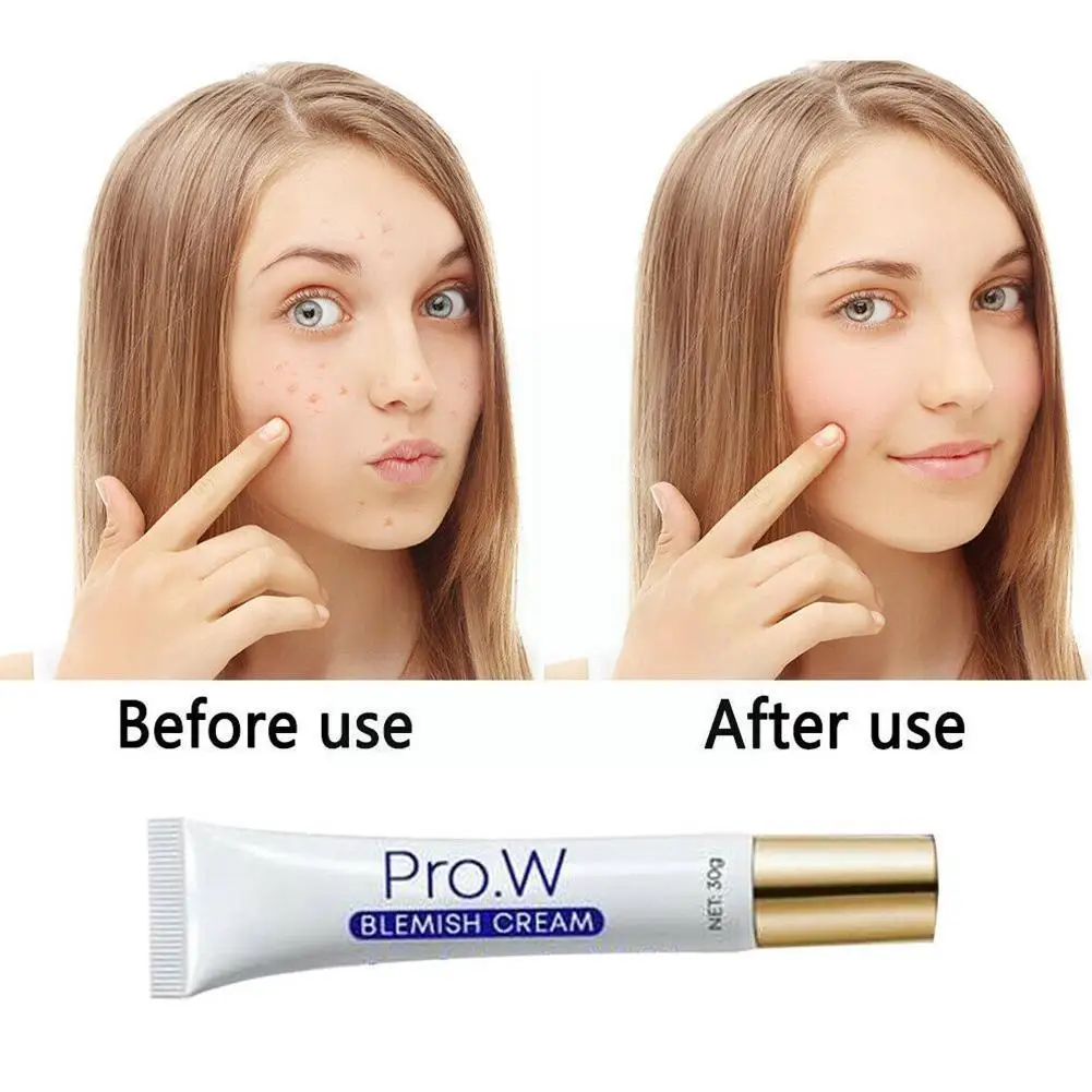 

Blemish Cream Pure Skin Anti Acne Scar Cream Freckles Removal Dark Acne Scar Spots Pimple Whitening Skin E4e0