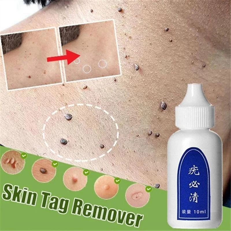 

Skin Tag Remover Chinese Medicine Body Warts Treatment Foot Corn Remover