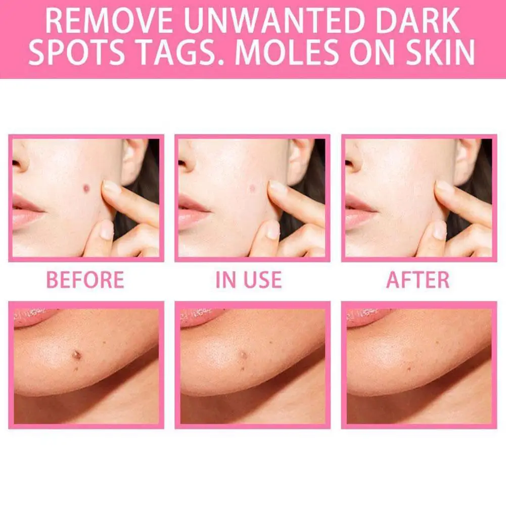 

20ML Liquid Wart Mole Removal Serum Organic Tags Solutions Serum Skin Tag Mole Freckle Spot Fast Remover Essence Skin Care