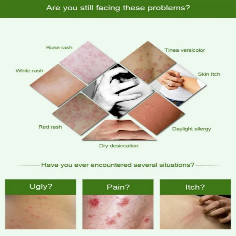 

Natural Chinese Cream Eczema Pruritus Ointment Herbal Anti Bacteria Body Cream Psoriasis Eczema Ointment