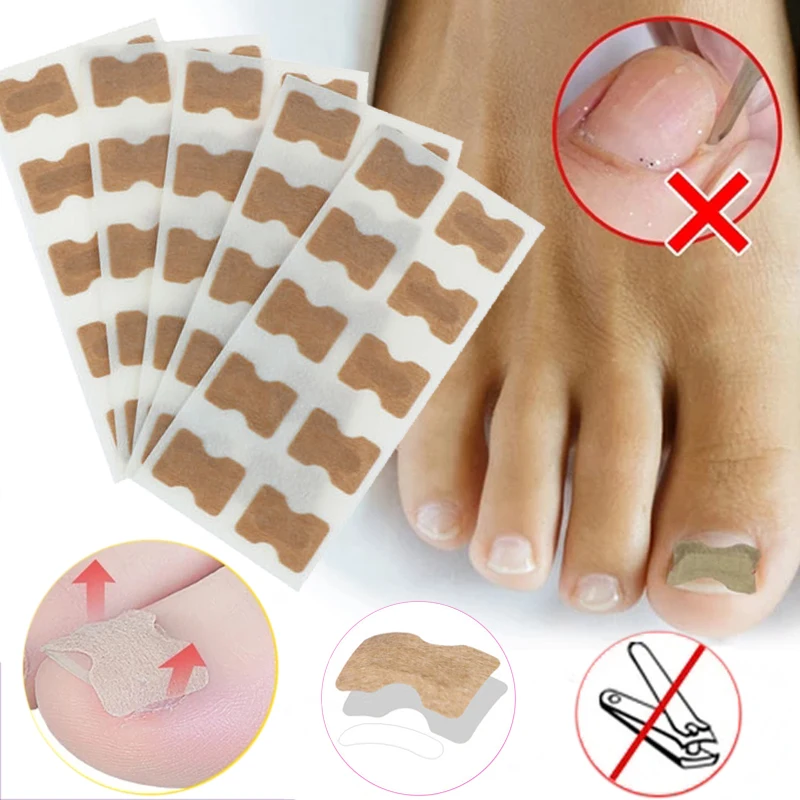 5pcs Glue Free Ingrown Toenail Patch Set Correction Pedicure Tools Inlay Nail Corrector Stickers Foot Care |