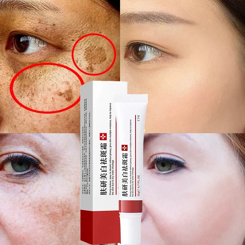 

Effective Whitening Freckle Cream Remove Dark Spots Anti Freckle Cream Fade Pigmentation Melasma Brighten Creams Skin Care 20g