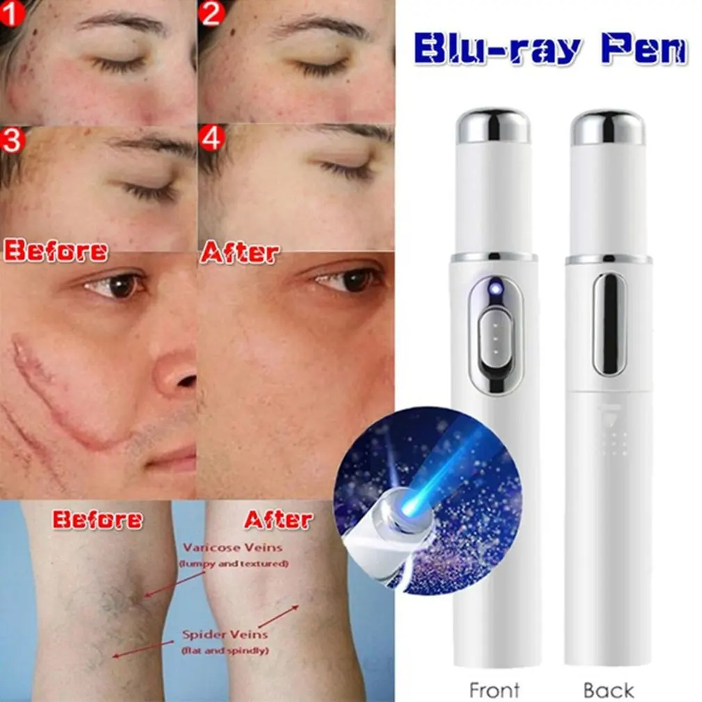Acne Laser Pen Portable Wrinkle Removal Machine Durable Soft Scar Remover Blue Therapy Light Massage Spider Vein Eraser | Красота и