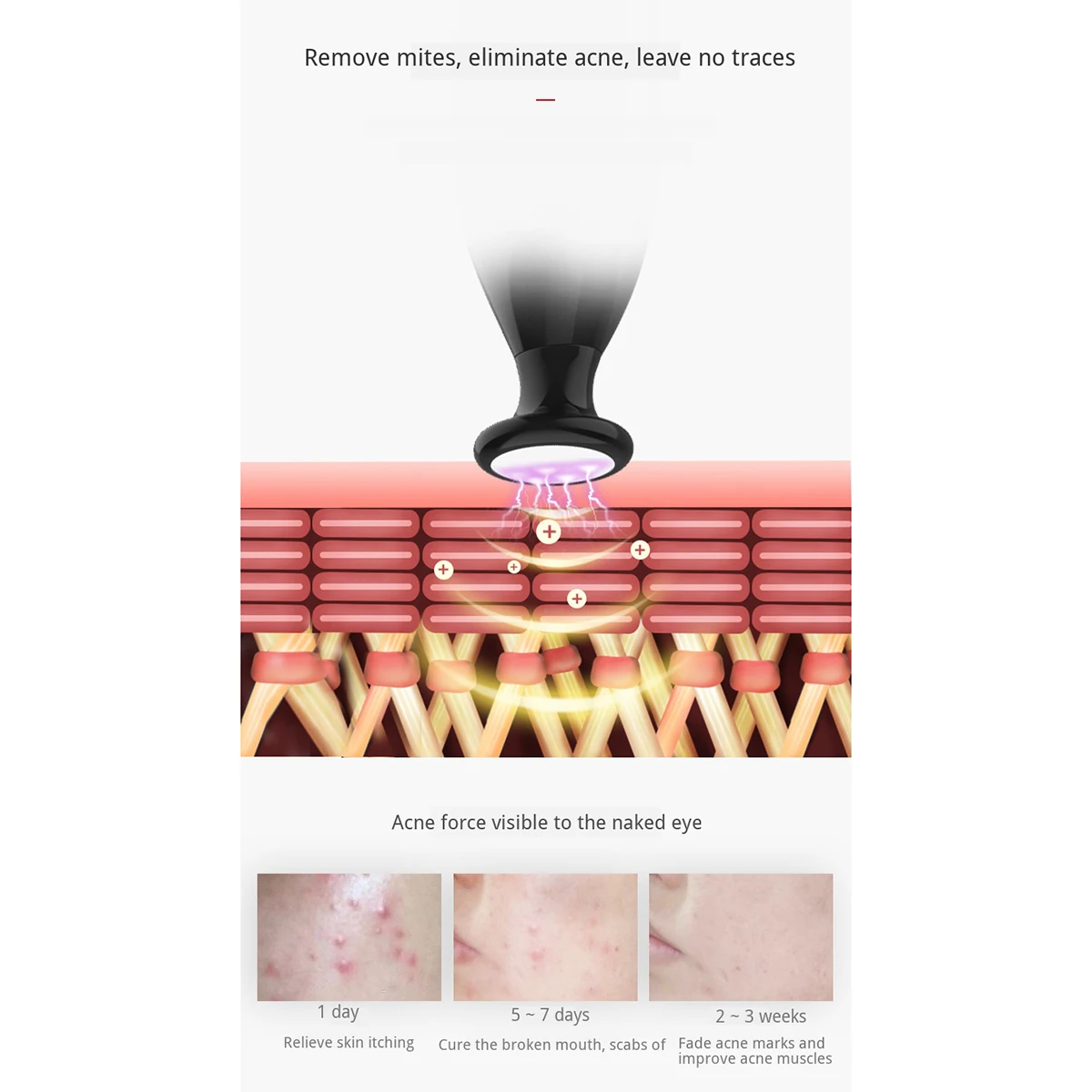 Голубой светильник плазменная ручка удаление рубцов прыщей морщин старения