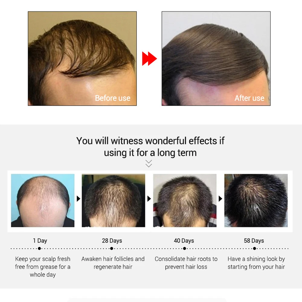 Эфирное масло имбиря для быстрого роста волос TCM эффективный экстракт против