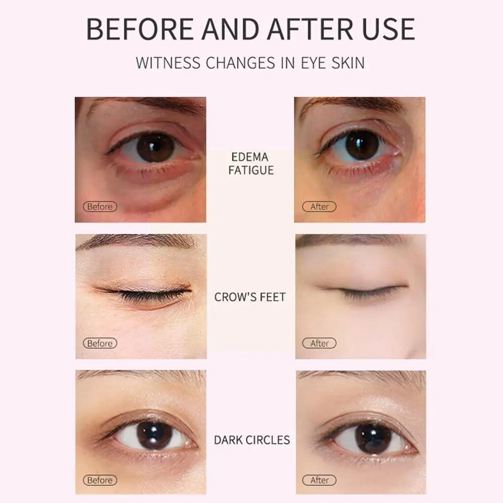 

Hyaluronic Acid Eye Care Crystal Female Eye Patch To Remove Anti-wrinkle Dark Gel Eye Anti-aging Eye Circles B1v6