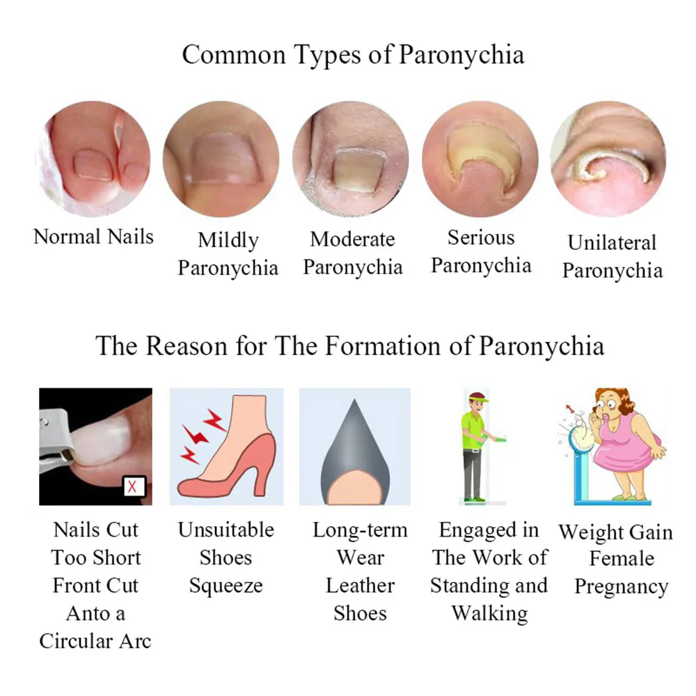 

Ifory 20Pcs Ingrown Toenail Correction Pedicure Foot Orthodontic Toe Thumb Nail Care Patches No Glue Needed Foot Care Tools