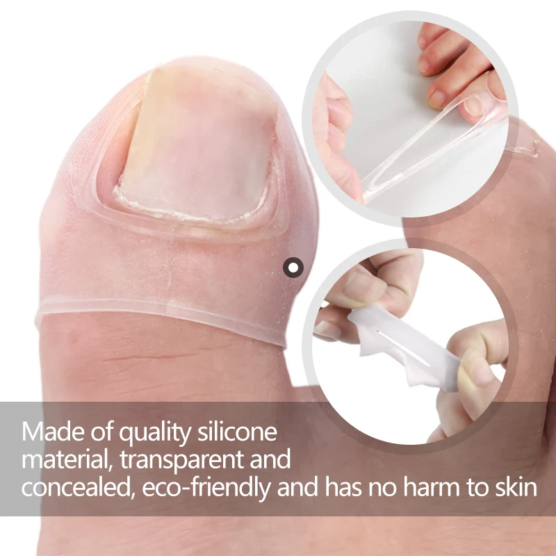 

2pc Silicone Orthognathic Silicone Ingrown Nail orthodontic Correction Orthodontic Pad Orthodontic Toe Nail Correction tool Set