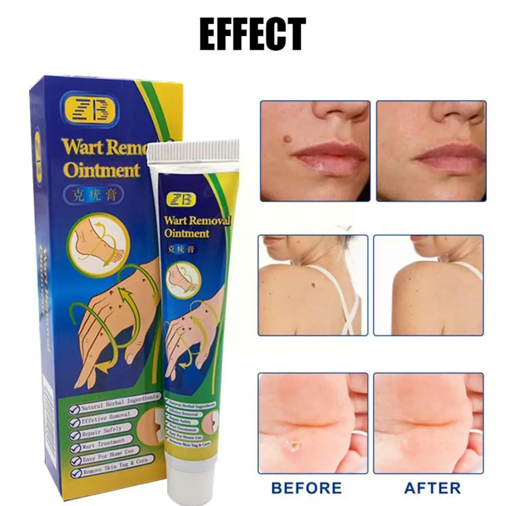 

Мазь для удаления бородавок, крем для лечения бородавок, кожи шеи, медицинская мазь для подмышек, бородавок, стоп, бородавок, плоский крем, мо...