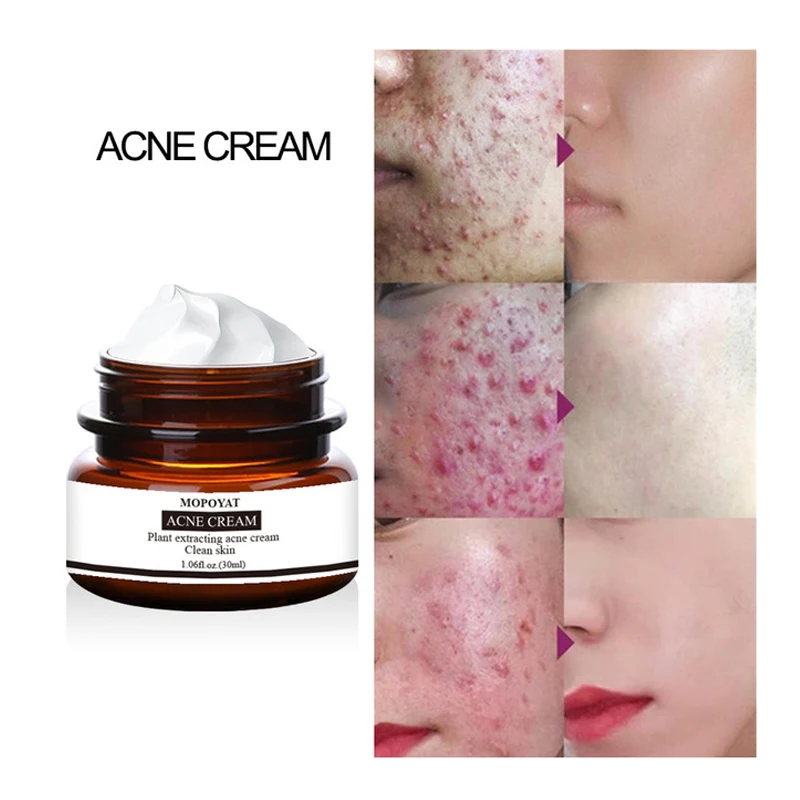 30 г крем от акне лечение угрей сокращение пор ремонт удаления контроль шрамов