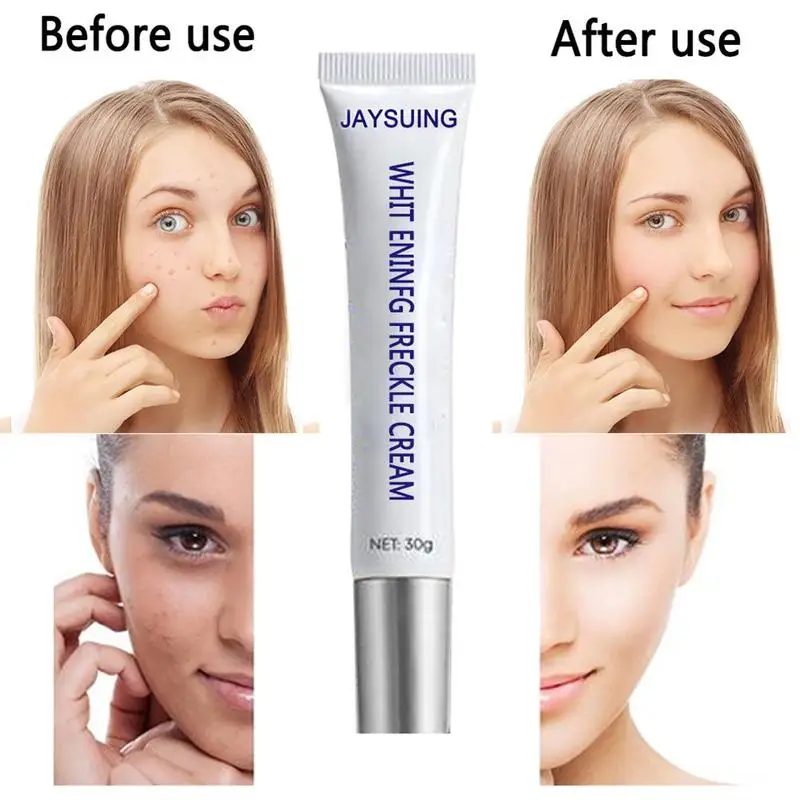 Blemish Cream Freckles Acne Pimple Scar Dark Spots Remove Skin Whitening Brightening