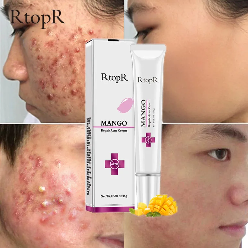 

Mango Repair Acne Cream Effective Remove Acne Marks Face Gel Oil Control Whitening Moisturizing Nourishing Skin Care Cosmetics