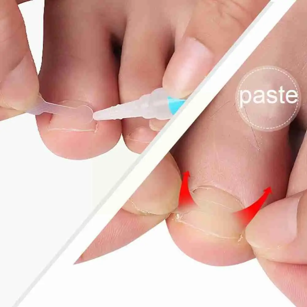 

10 Transparent Nail Correction Tablets Ingrown Toenail Treatment Correction Patch Elastic Tool Pedicure Z6g9