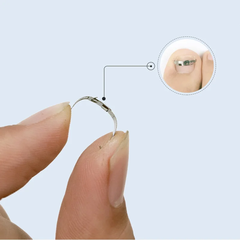 Инструменты для педикюра вросших ногтей на ногах профессиональное лечение