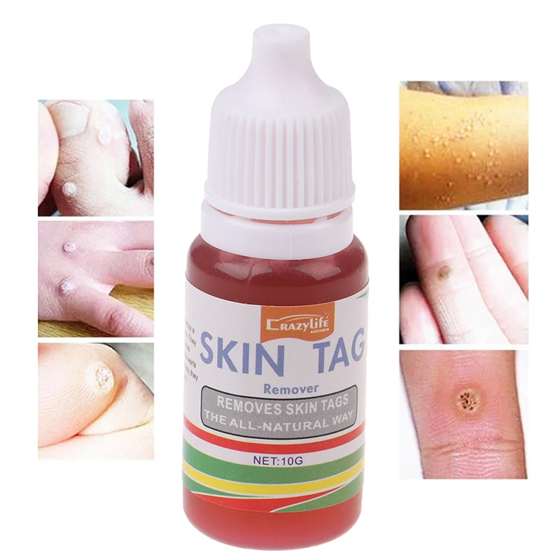

10ML Body Warts Treatment Cream Skin Tag Remover Foot Corn Removal Plantar Genital Warts Ointment Foot Care Cream Dropshopping