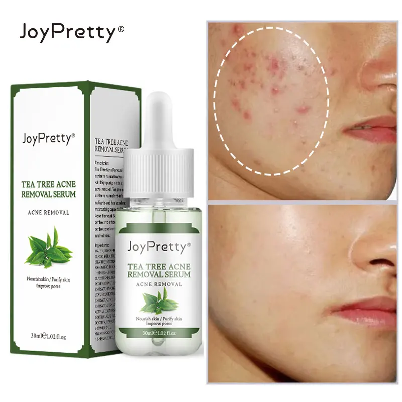 Эффективная Сыворотка для удаления прыщей на лице от акне | Красота и здоровье
