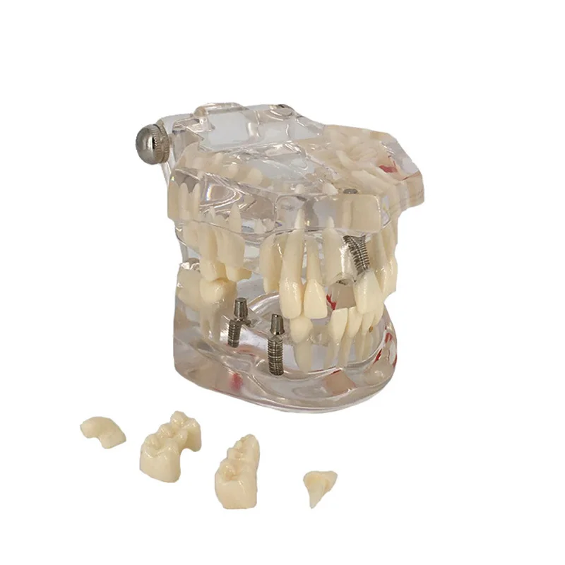 Модель имплантата для восстановления зубов прозрачная модель с мостом