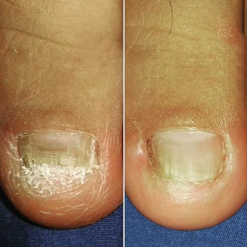 

2020 New Fungus Repair Treatment Pen Onychomycosis Anti Paronychia Infection Nail Pen Fungal Care H8D5