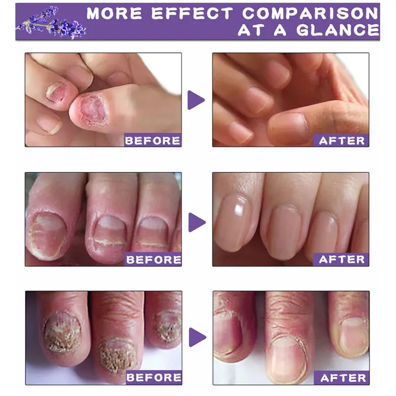 

Herbal Fungal Nail Treatment Essential Oil Nail Art & Tools Promote Nails Grow Healthy Nail Treatment Onychomycosis Foot Care