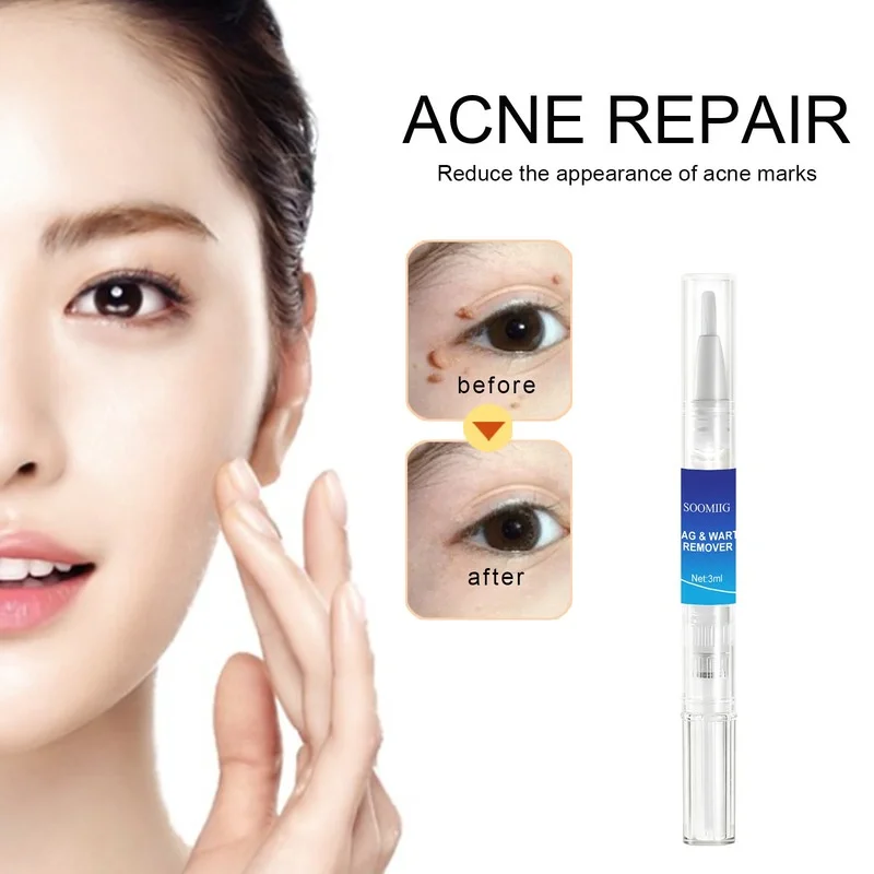 

Removing Against Moles Remover Anti Verruca Remedy Liquid Pen Treatment Papillomas Removal of Warts Liquid From Skin Tags