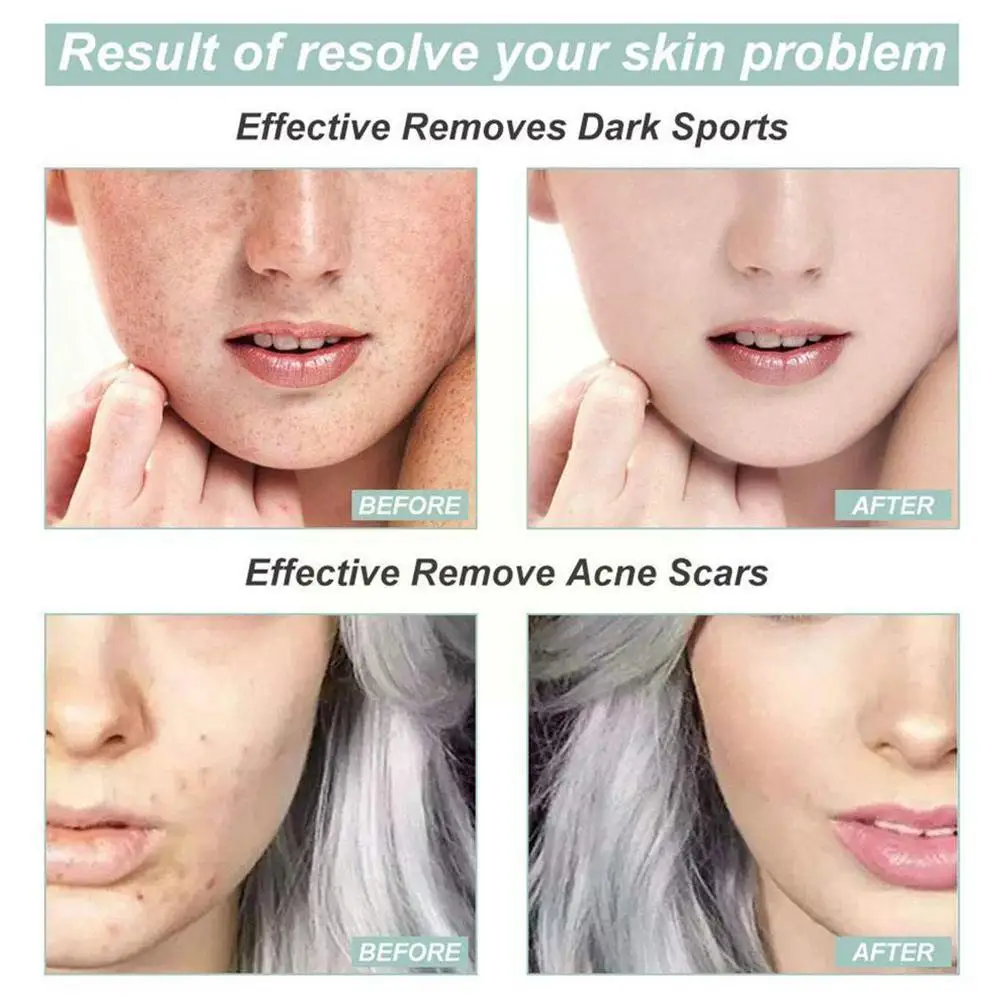 Effective Whitening Freckle Cream Remove Melasma Acne Melanin Moisturizing Pigmentation Dark Pigment Spot S V5k4 | Красота и здоровье