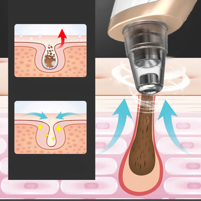 Удаление угрей массаж лица глубокое очищение носа поры акне прыщей вакуумное