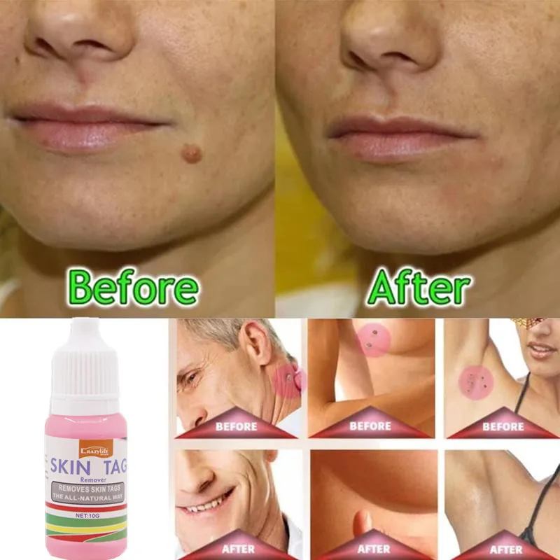 Средство для удаления кожных тегов 12 часов Tu kill Medical Remover Skin Tag Mole & Genital средство