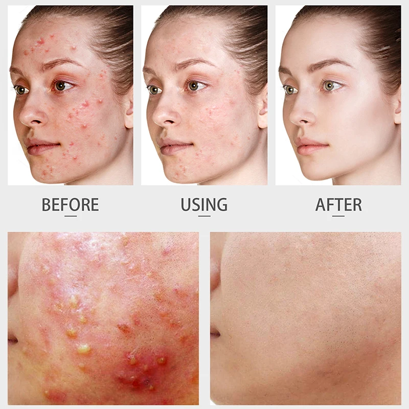 30 г лечение акне очищающий крем для лица против сокращение пор удаление жирной