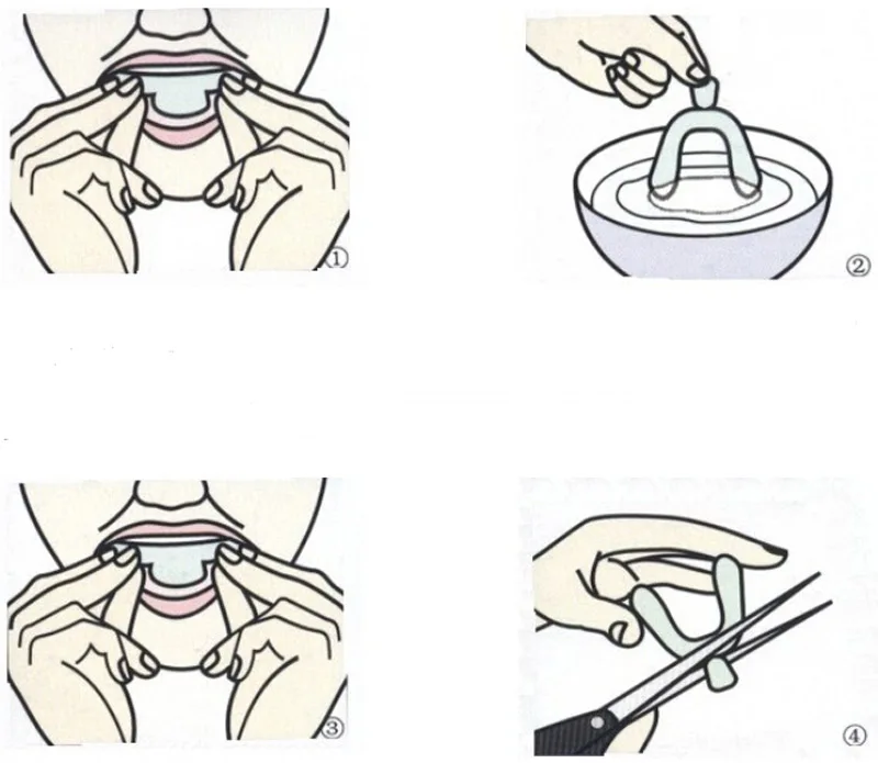 Прозрачные индивидуальные литые ротовые термоформы для отбеливания зубов