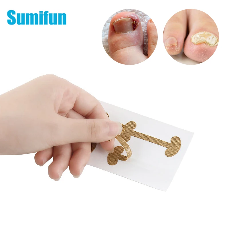 12 шт. патчи для лечения паронихии инструмент коррекции вросших ногтей