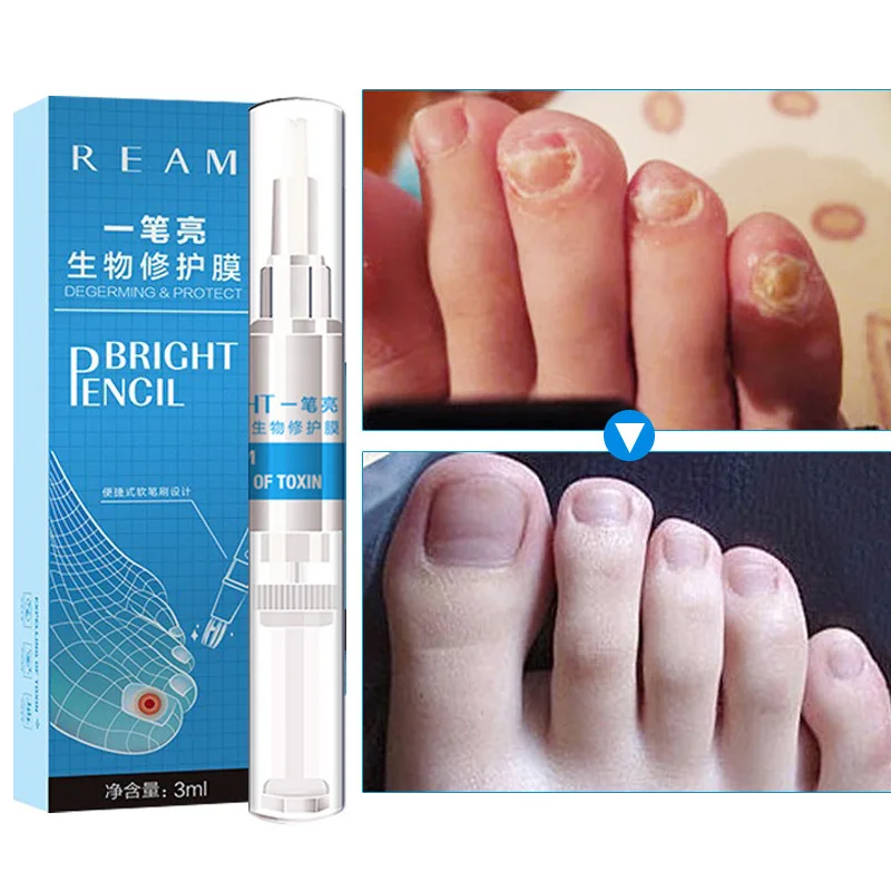 

Repair Liquid Remove fungus Ringworm Nails Biology foot feet hand fungal nail treatment care schimmel nagel behandeling cuticole