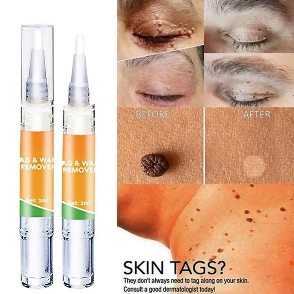 

Wart Treatment Cream Warts Removal Herbal Ointment Remover Herbal Extract Plaster Warts Ointment Skin Beauty Removing Wart Pen