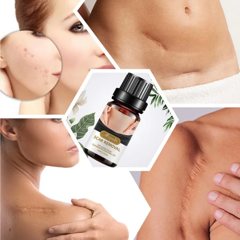 

10ml Effective Remover Obesity Postpartum Marks Natural Stretch Marks Improve Skin Dryness Essential Oils Pure Anti Repair Cream