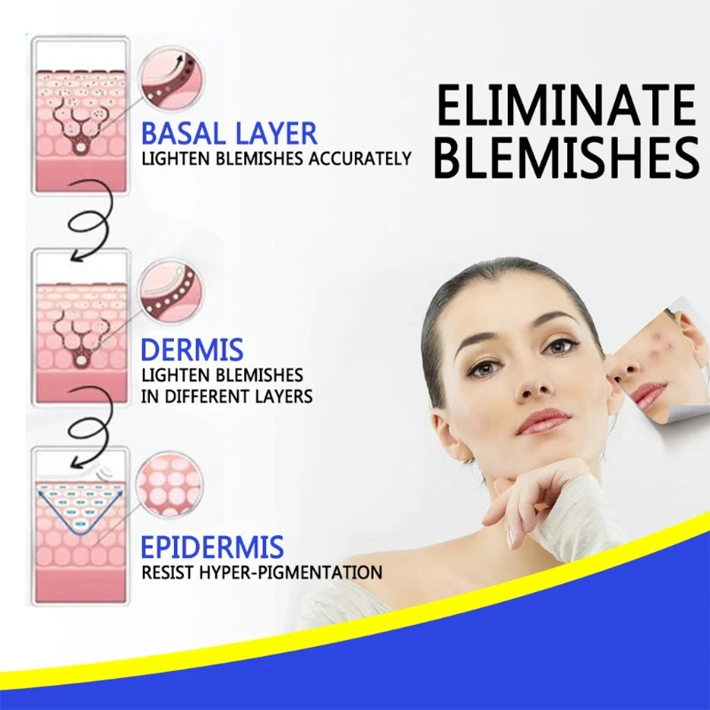 30g Face Blemish Freckle Cream Pimple Acne Treatment Scar Dark Spots Removal U2JD
