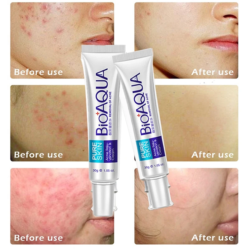 

Effective Acne Removal Cream Acne Treatment Fade Acne Spots Oil Control Shrink Pores Whitening Moisturizing Acne Cream Skin Care