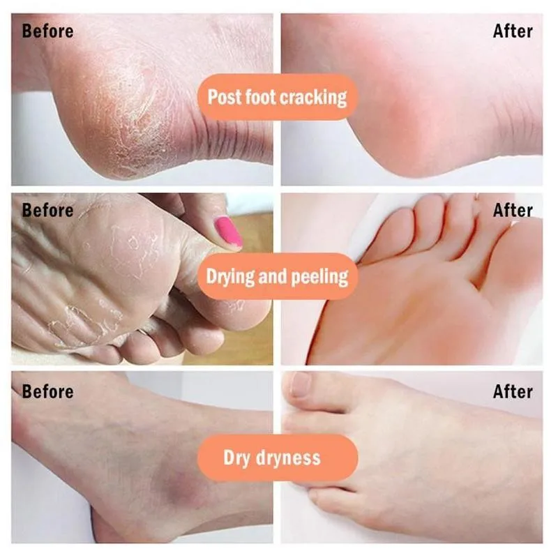 

1 Pair Peeling Foot Mask Removal Dead Skin Calluses Whitening And Moisturizing Patch Detox Exfoliating Feet Masks Health Care