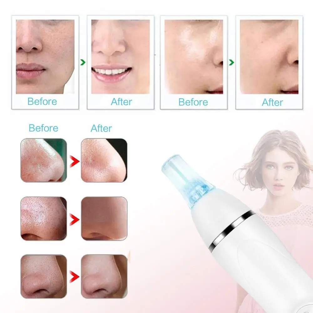 Электрический инструмент для удаления чёрных точек аппарат алмазной